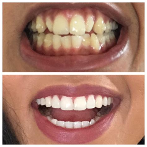 crest white strips 18|crest strips before and after.